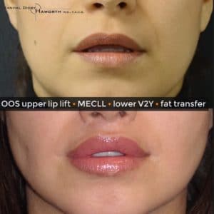 Lip reshaping via upper lip lift, corner lip lift and fat transfer via Caisson technique
