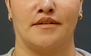 After a "modified "upper lip lift 