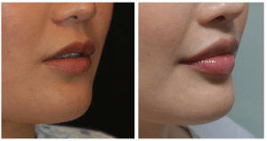 Upper lip lift enhancement