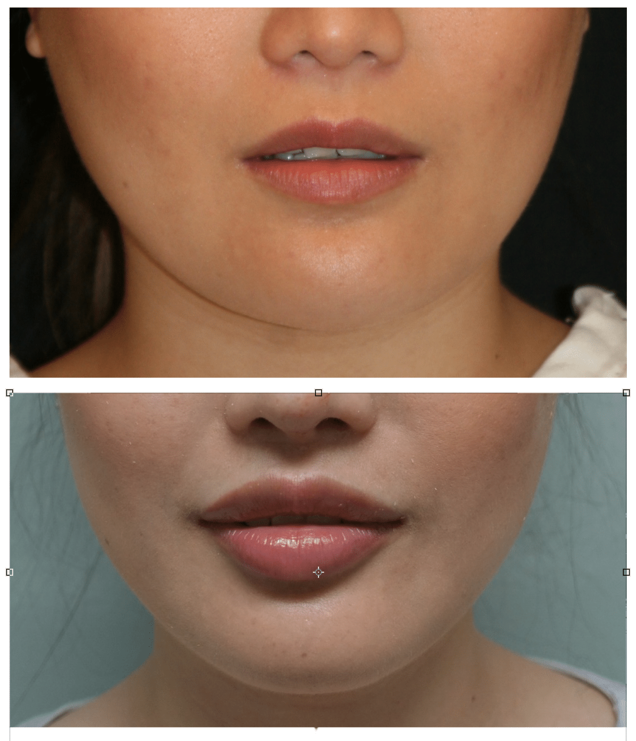 Beautiful Upper Lip Lifts without scars? 