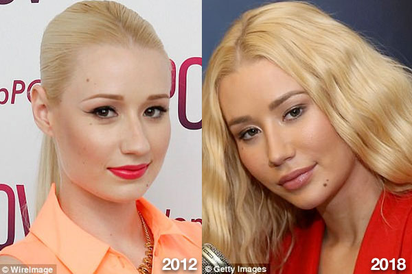 Has Iggy Azalea Transformed Her Face Dr Haworth