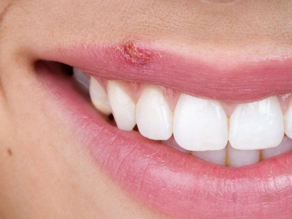 Cold sore herpes Simplex Type I of the lips