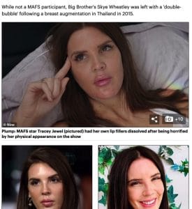 Over inflated "duck lips"