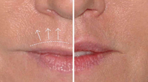 A before and after of a conservative upper lip liftA before and after of a conservative upper lip lift