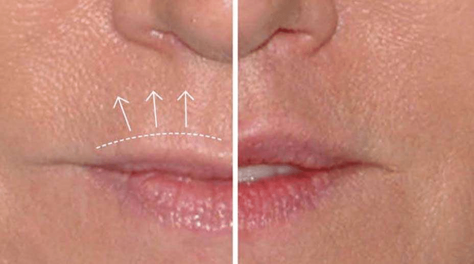 A before and after of a conservative upper lip liftA before and after of a conservative upper lip lift