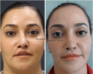 Neonatal lip deformity stemming from past upper lip lift.