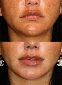 Overfilled lips due to both patient and practitioner perception drift