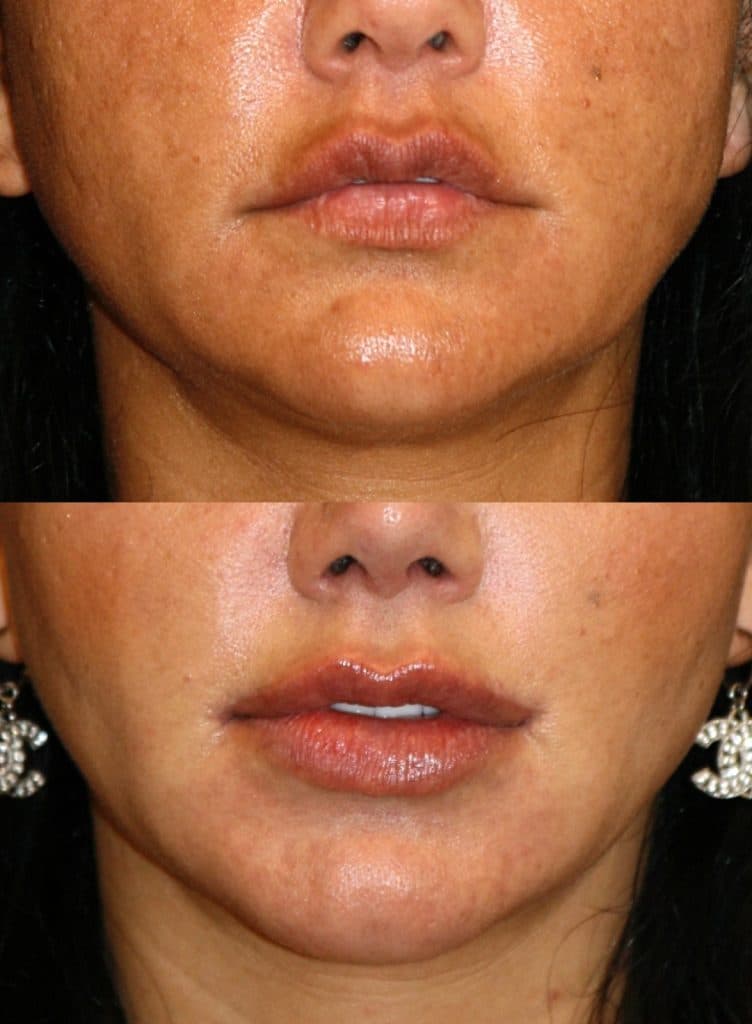 Overfilled lips due to both patient and practitioner perception drift