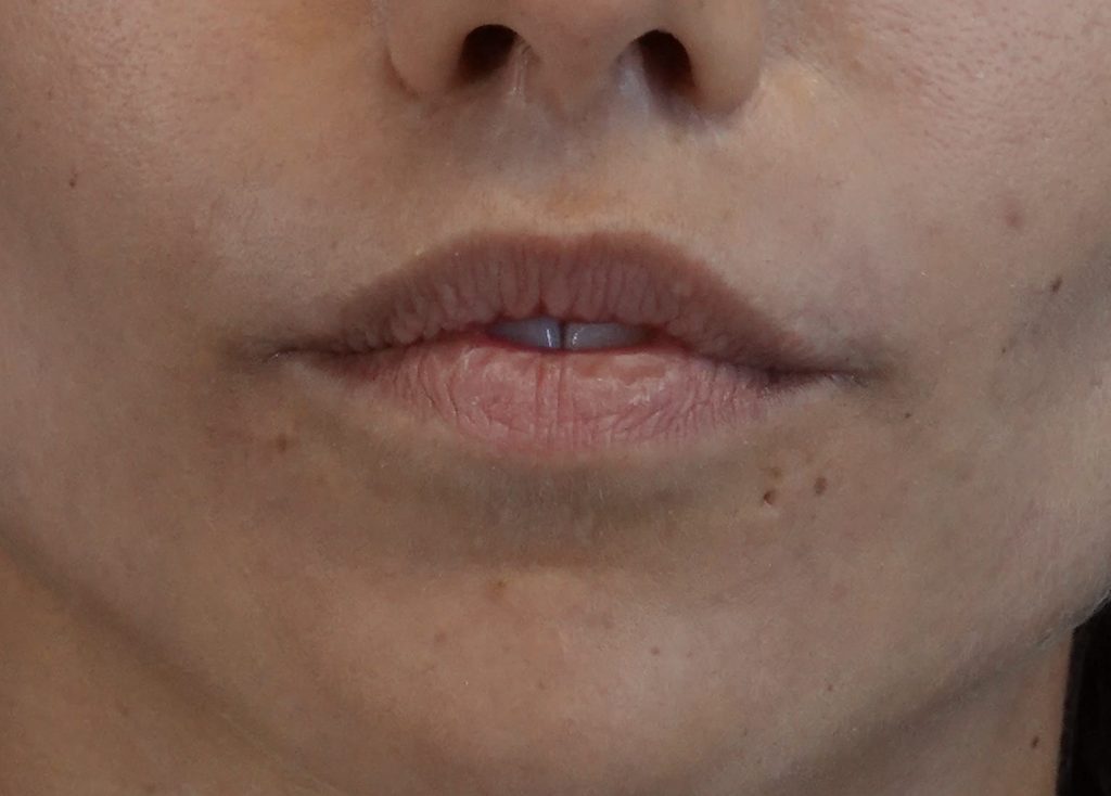 A moderate neonatal lip deformity