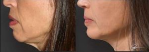 Before-and-after images of chin implant surgery correcting a recessed chin, lifting a forward-hanging lower lip, and tightening loose submental skin.