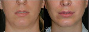 Before-and-after comparison of an anatomic extended chin implant showing reduced vertical shadow wings between the lower lip and chin, improving lower face harmony.